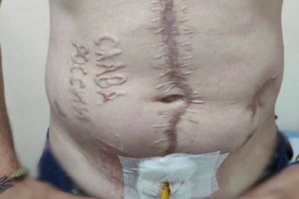 gur pidtverdilo spravzhnist foto z napisom slava rosid197 na tili zvilnenogo z rosijskogo polonu zaxisnika 6848b98178f23 ГУР підтвердило справжність фото з написом «Слава Росії» на тілі звільненого з російського полону захисника