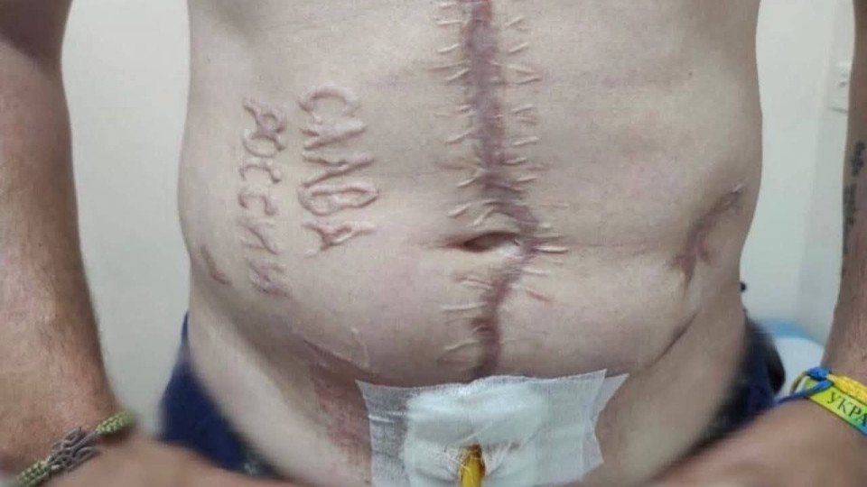 gur pidtverdilo spravzhnist foto z napisom slava rosid197 na tili zvilnenogo z rosijskogo polonu ГУР підтвердило справжність фото з написом «Слава Росії» на тілі звільненого з російського полону захисника